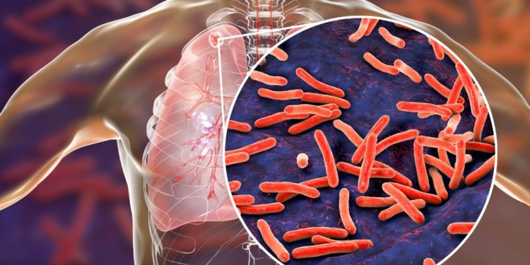 Diagnóstico rápido da tuberculose