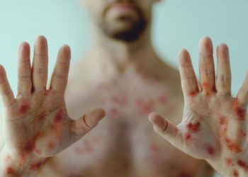 Varíola dos macacos