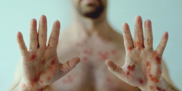 Varíola dos macacos