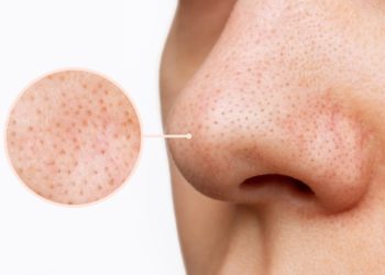 Como remover cravos sem causar danos à pele, segundo dermatologistas