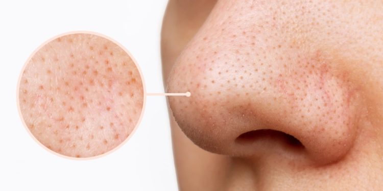 Como remover cravos sem causar danos à pele, segundo dermatologistas